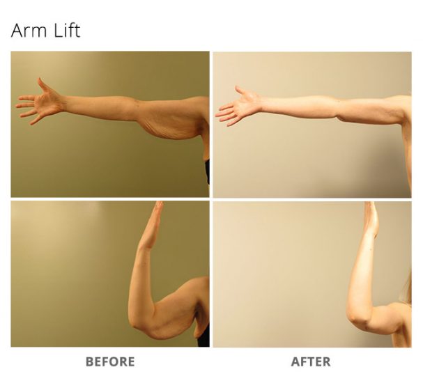 Arm Lift MSA Plastic Surgery