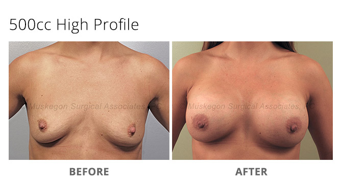 breast augmentation 1 - Breast Augmentation