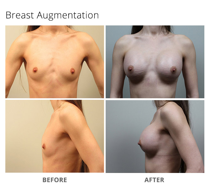 breast augmentation 10 - Breast Augmentation