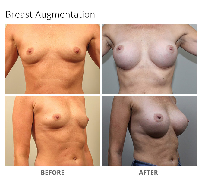 breast augmentation 11 - Breast Augmentation