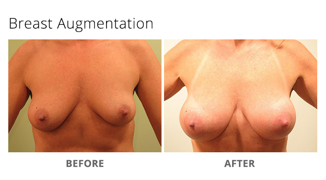 breast augmentation 12 - Breast Augmentation