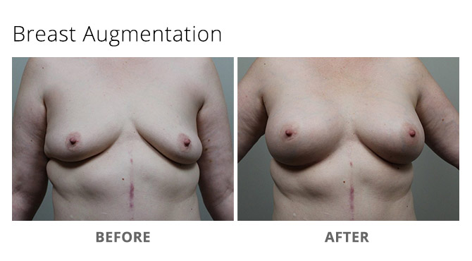 breast augmentation 13 - Breast Augmentation