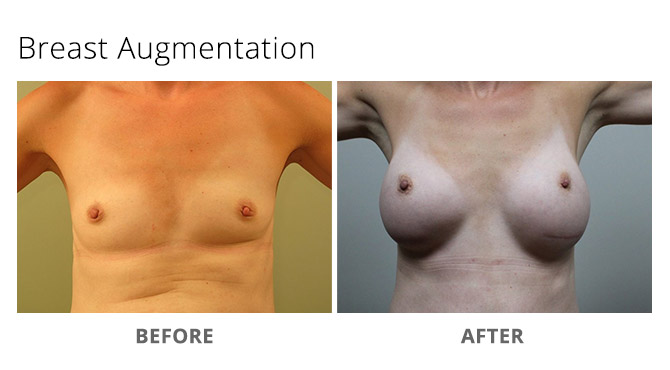 breast augmentation 15 - Breast Augmentation