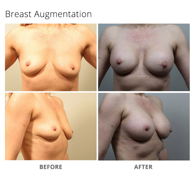 breast augmentation 18 - Breast Augmentation