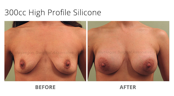 breast augmentation 2 - Breast Augmentation