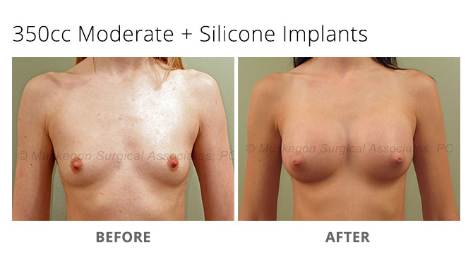 breast augmentation 3 - Breast Augmentation