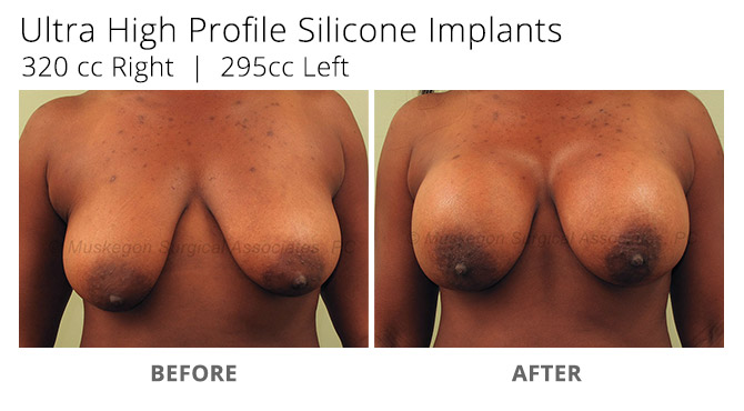 breast augmentation 4 - Breast Augmentation