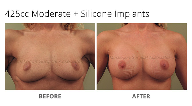 breast augmentation 5 - Breast Augmentation