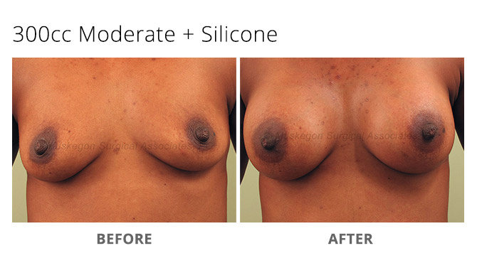 breast augmentation 6 - Breast Augmentation