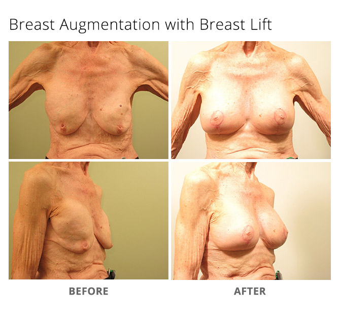 Breast Augmentation - MSA Plastic Surgery