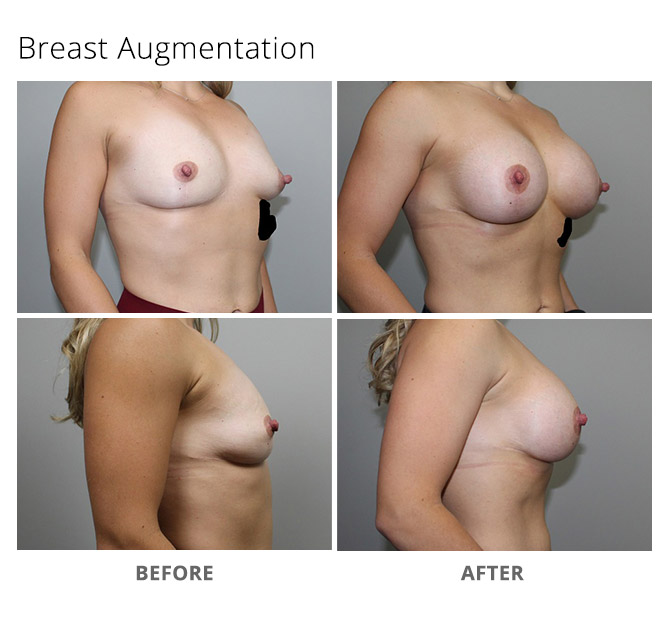 breast augmentation 9 - Breast Augmentation