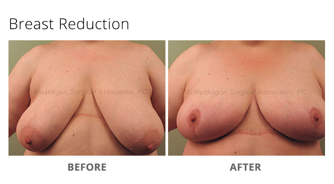breast reduction 5 - Breast Reduction