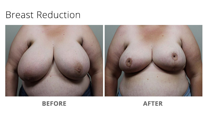 breast reduction 8 - Breast Reduction