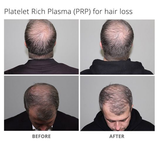 Platelet Rich Plasma Prp For Hair Loss Msa Plastic Surgery