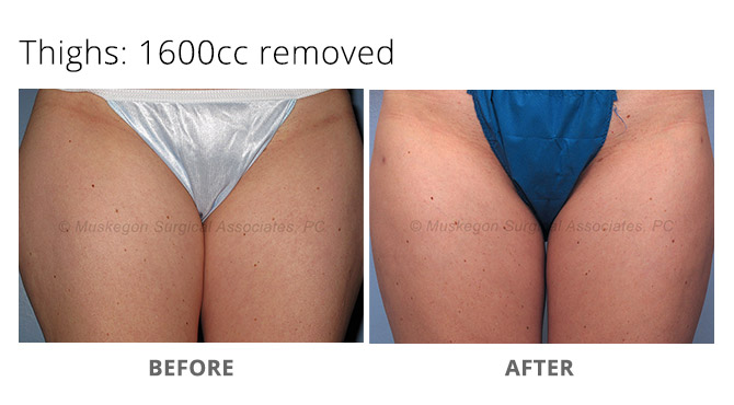 Laser Liposuction Touch Ups