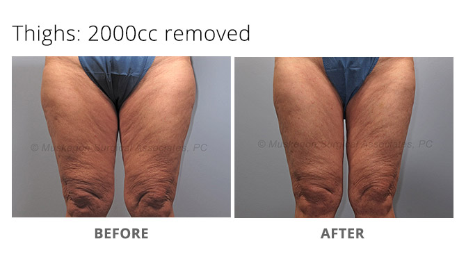 What is Laser Liposuction?