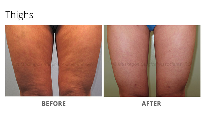 laser lipo 3 - Laser Lipo