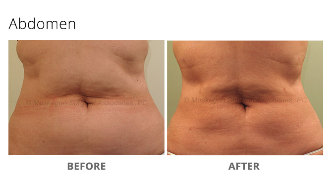 Laser Lipo - MSA Plastic Surgery