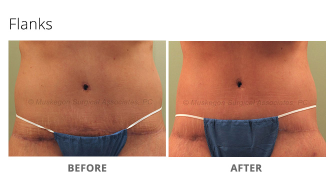 laser lipo 5 - Laser Lipo