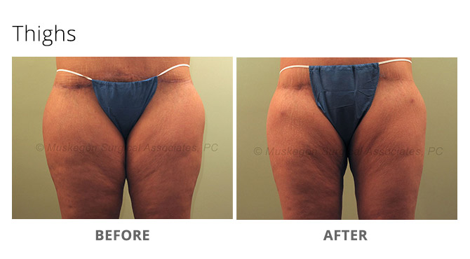 laser lipo 6 - Laser Lipo