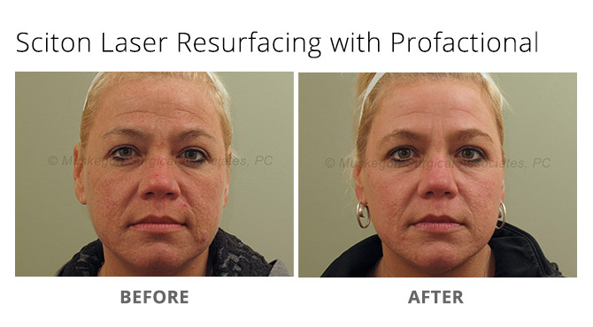 laser skin resurfacing 1 - Sciton Laser Treatments