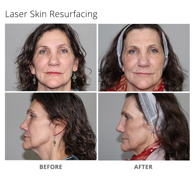 laser skin resurfacing 2 - Sciton Laser Treatments