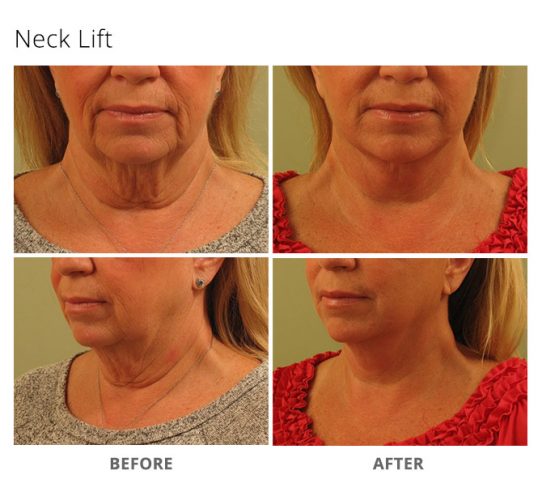 Neck Lift - MSA Plastic Surgery