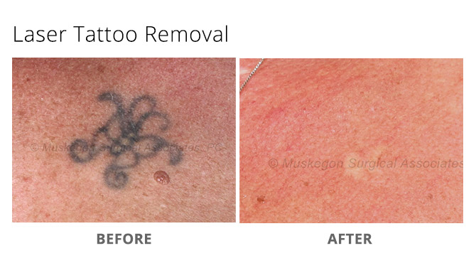 tattoo removal 1 - Laser Tattoo Removal