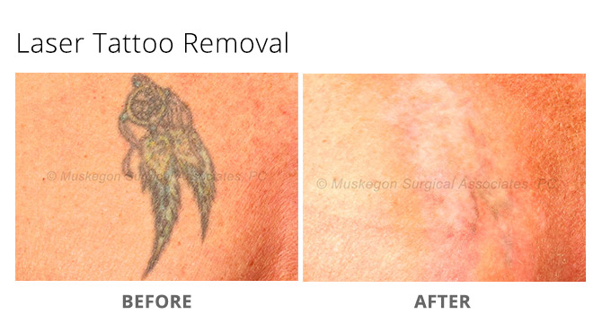 tattoo removal 2 - Laser Tattoo Removal