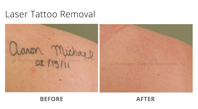 tattoo removal 3 - Laser Tattoo Removal