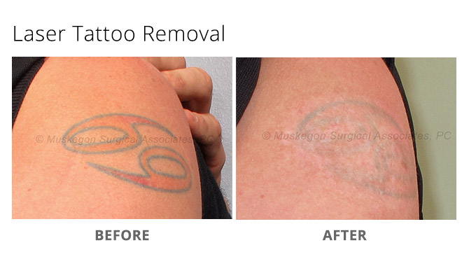 Laser Tattoo Removal Before  After Photos New Jersey  Reflections