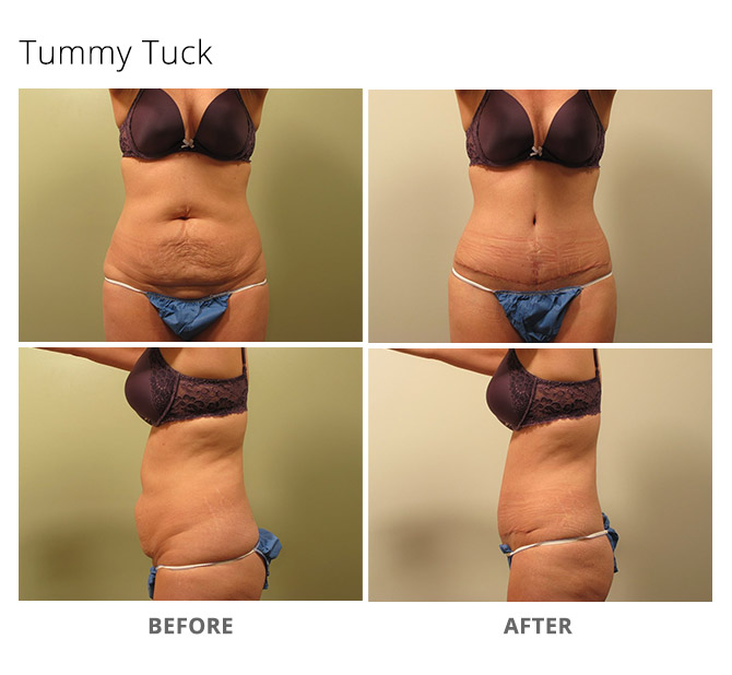 tummy tuck 6 - Tummy Tuck