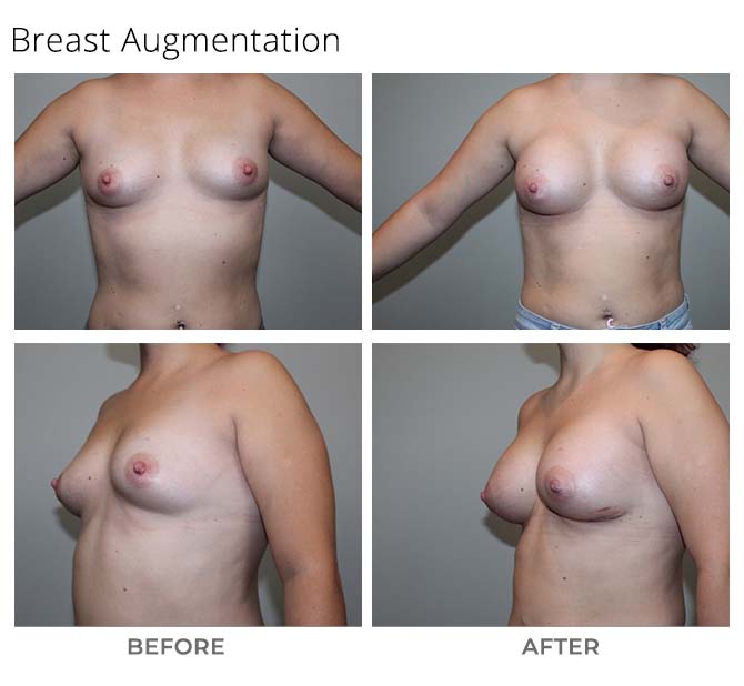 Untitled 1 - Breast Augmentation