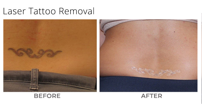 tattoo - Laser Tattoo Removal