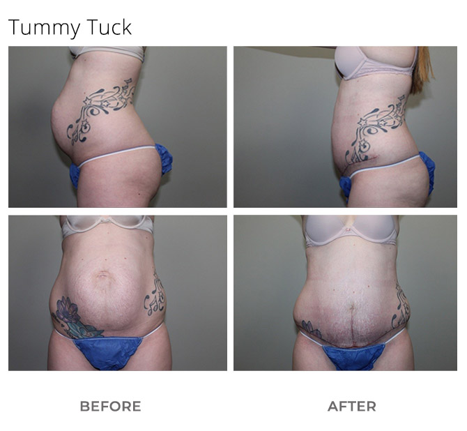 Tummy Tuck - MSA Plastic Surgery
