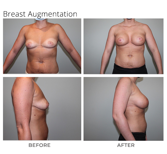 breast aug 2 - Breast Augmentation