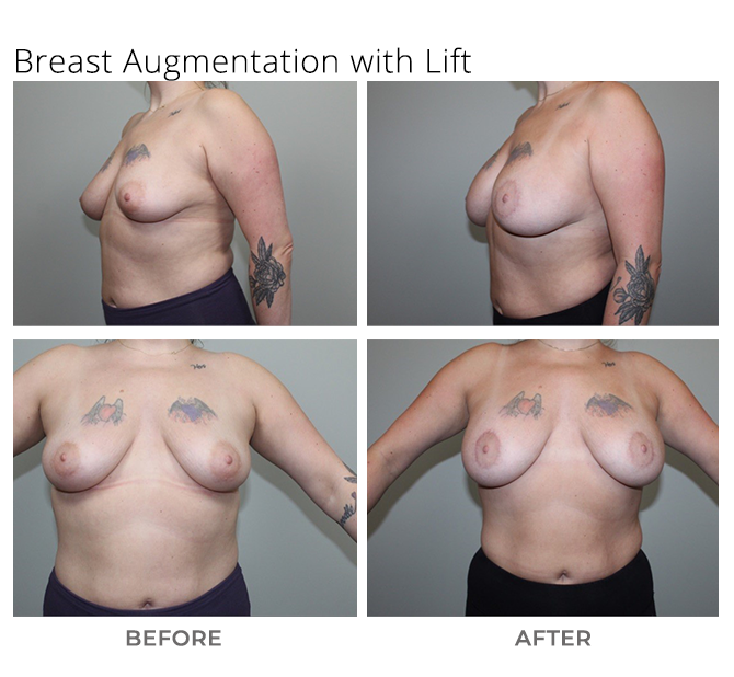 breast aug lift - Breast Augmentation