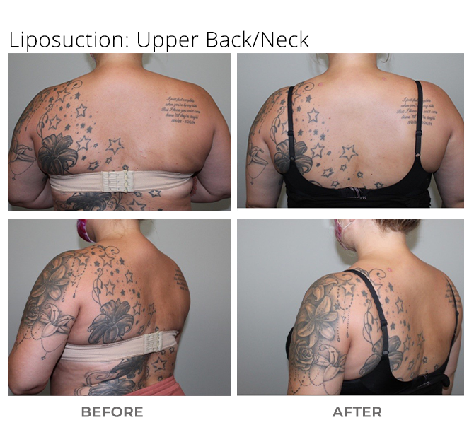 lipo 2 - Liposuction