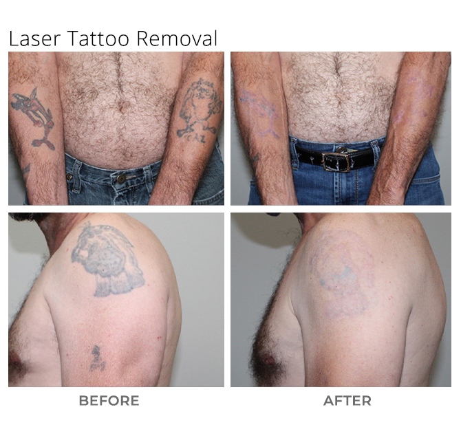 Laser Tattoo Removal - MSA