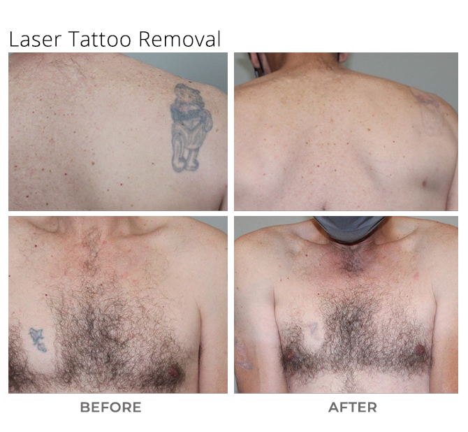 Laser Tattoo Removal - MSA Plastic Surgery