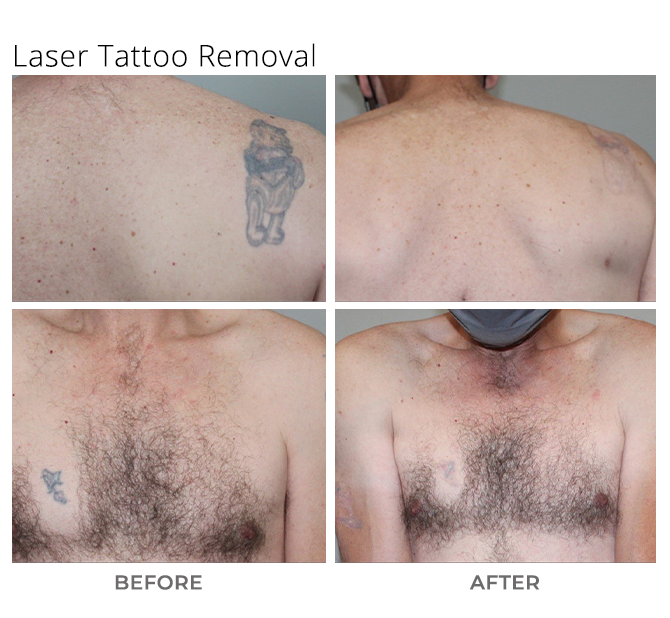 How Tattoo Removal Works - PureMD