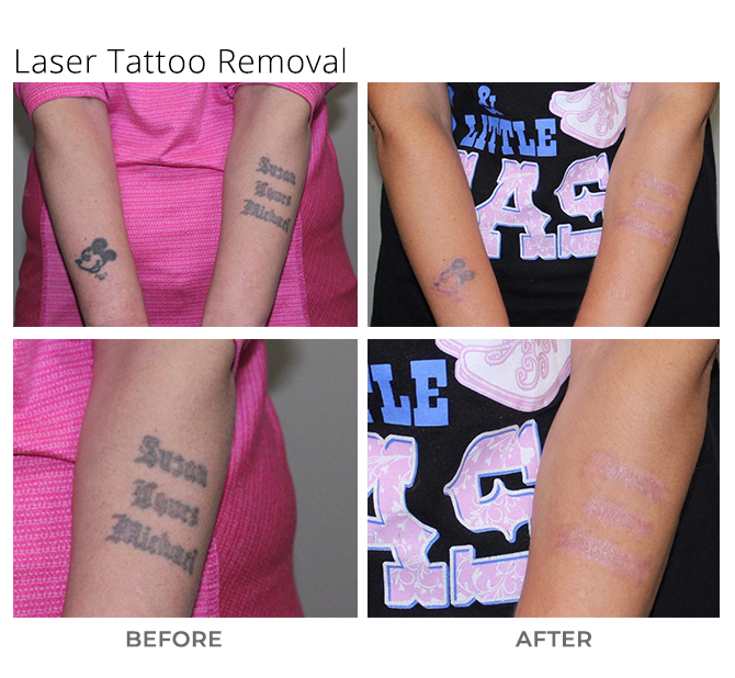 tat - Laser Tattoo Removal