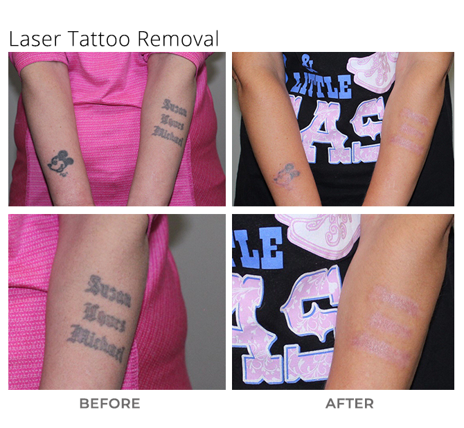 Safe, Fast Laser Tattoo Removal in Vancouver with enlighten® laser