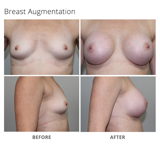 breast augmentation 10 update - Breast Augmentation