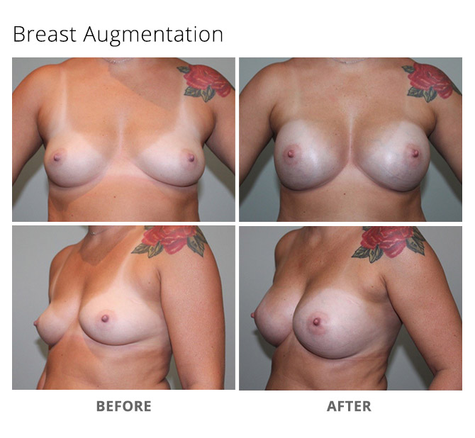 breast augmentation 19 - Breast Augmentation