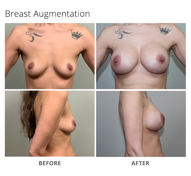 breast augmentation 22 - Breast Augmentation