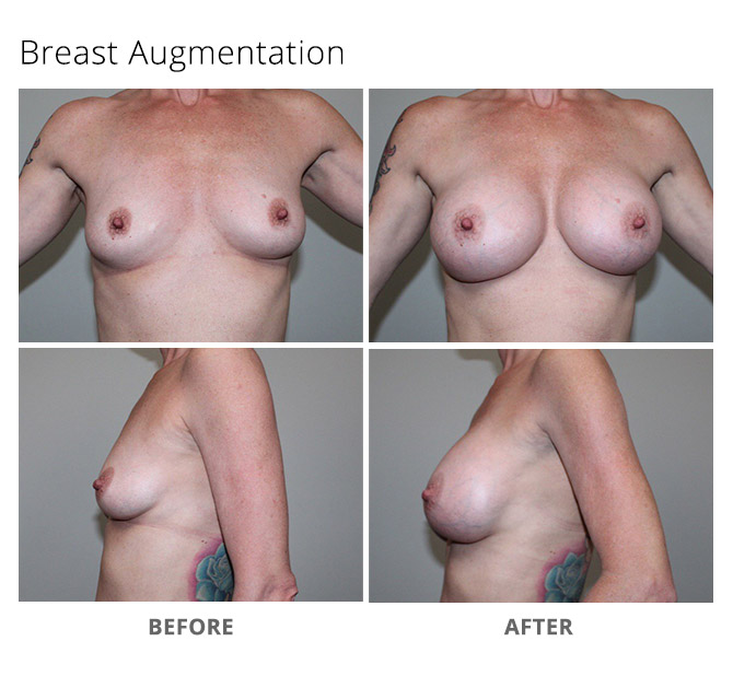 breast augmentation 23 - Breast Augmentation
