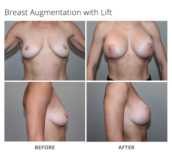 breast augmentation 26 - Breast Augmentation