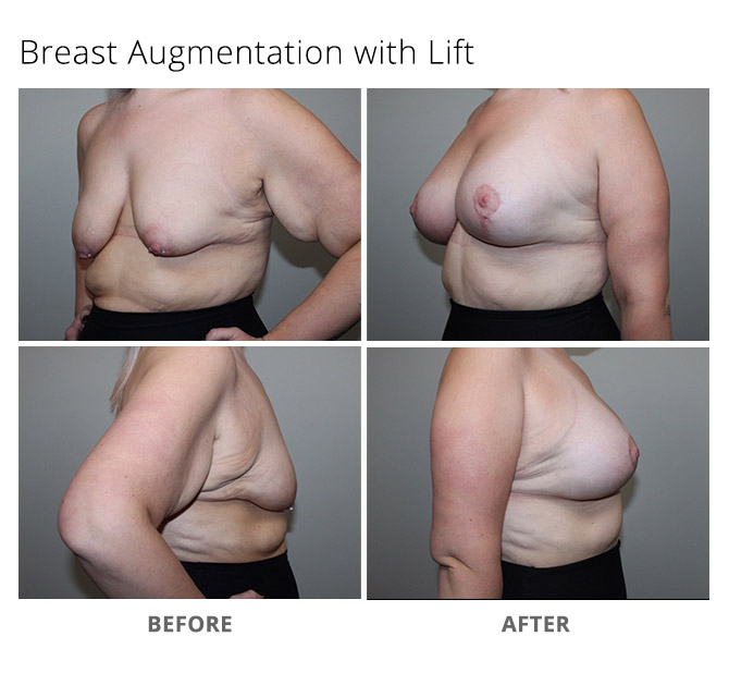 breast augmentation 27 - Breast Augmentation