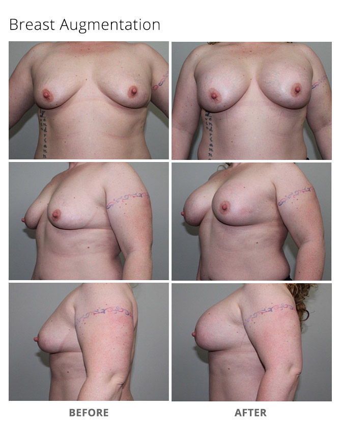 breast augmentation 8 update - Breast Augmentation